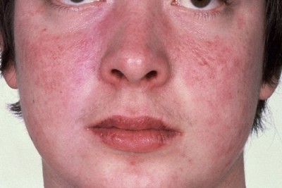 Bệnh lupus ban đỏ biến chứng thận có nguy hiểm không?
